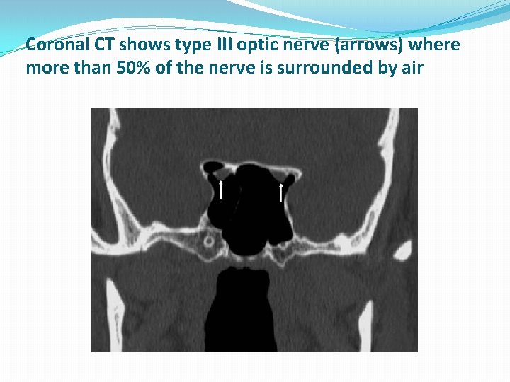Coronal CT shows type III optic nerve (arrows) where more than 50% of the Coronal CT shows type III optic nerve (arrows) where more than 50% of the