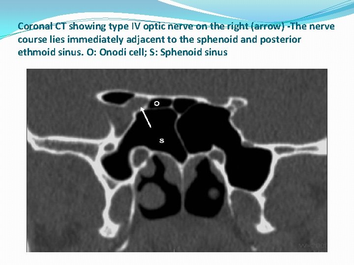 Coronal CT showing type IV optic nerve on the right (arrow) -The nerve course Coronal CT showing type IV optic nerve on the right (arrow) -The nerve course