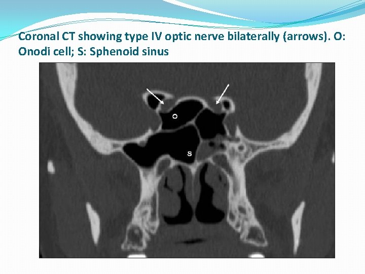 Coronal CT showing type IV optic nerve bilaterally (arrows). O: Onodi cell; S: Sphenoid Coronal CT showing type IV optic nerve bilaterally (arrows). O: Onodi cell; S: Sphenoid