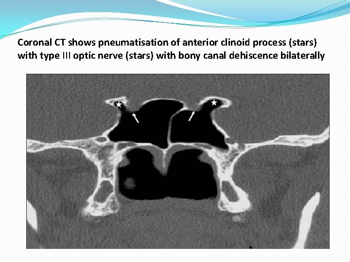 Coronal CT shows pneumatisation of anterior clinoid process (stars) with type III optic nerve Coronal CT shows pneumatisation of anterior clinoid process (stars) with type III optic nerve