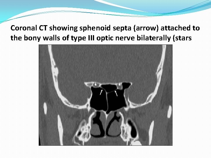 Coronal CT showing sphenoid septa (arrow) attached to the bony walls of type III Coronal CT showing sphenoid septa (arrow) attached to the bony walls of type III