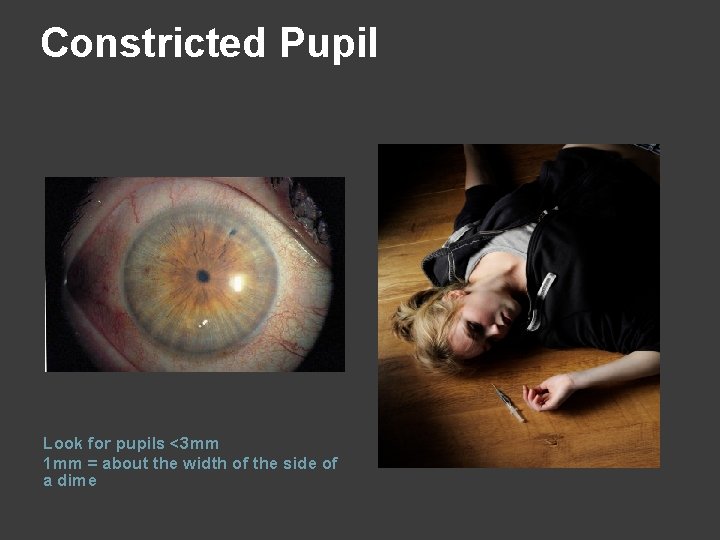 Constricted Pupil Look for pupils <3 mm 1 mm = about the width of