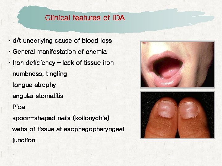 Clinical features of IDA • d/t underlying cause of blood loss • General manifestation