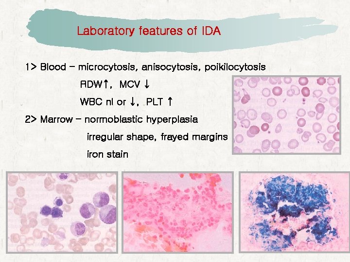 Laboratory features of IDA 1> Blood – microcytosis, anisocytosis, poikilocytosis RDW↑, MCV ↓ WBC