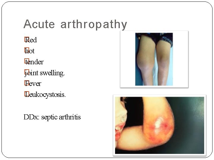 Acute arthropathy � Red � hot � tender � joint swelling. � Fever �