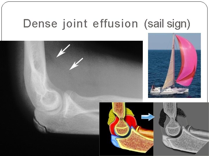 Dense joint effusion (sail sign) 