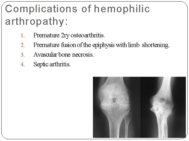 Complications of hemophilic arthropathy: 1. 2. 3. 4. Premature 2 ry osteoarthritis. Premature fusion