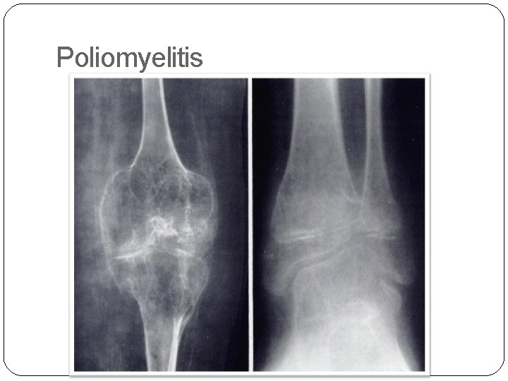 Poliomyelitis 