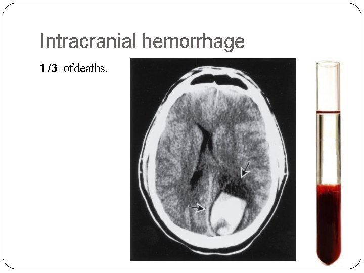 Intracranial hemorrhage 1/3 of deaths. 