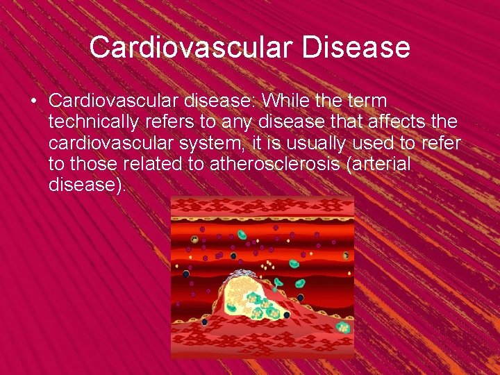 Cardiovascular Disease • Cardiovascular disease: While the term technically refers to any disease that