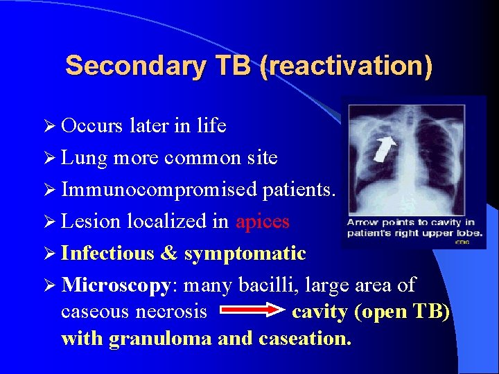 Secondary TB (reactivation) Ø Occurs later in life Ø Lung more common site Ø