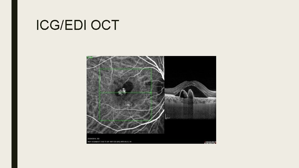 ICG/EDI OCT 