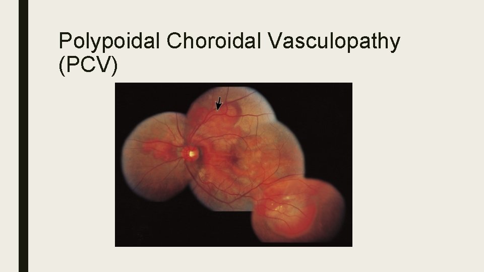 Polypoidal Choroidal Vasculopathy (PCV) 