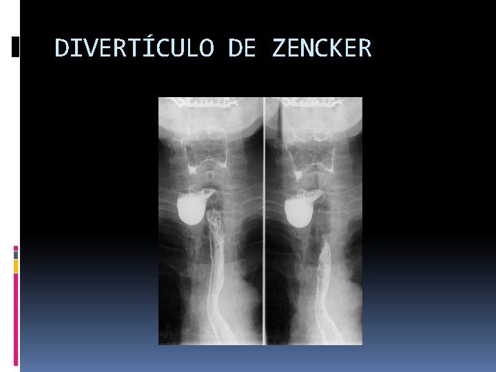 DIVERTÍCULO DE ZENCKER 