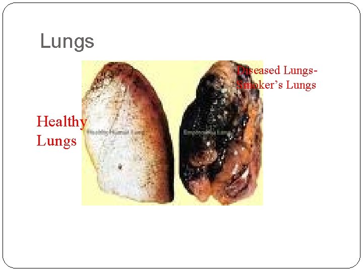 Lungs Diseased Lungs- Smoker’s Lungs Healthy Lungs 