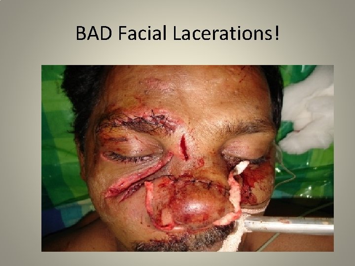 BAD Facial Lacerations! 
