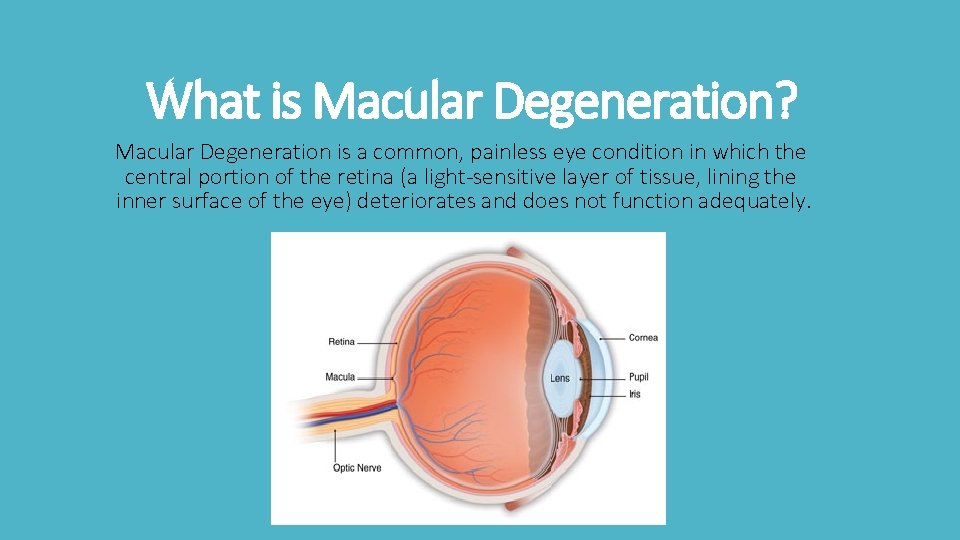 What is Macular Degeneration? Macular Degeneration is a common, painless eye condition in which