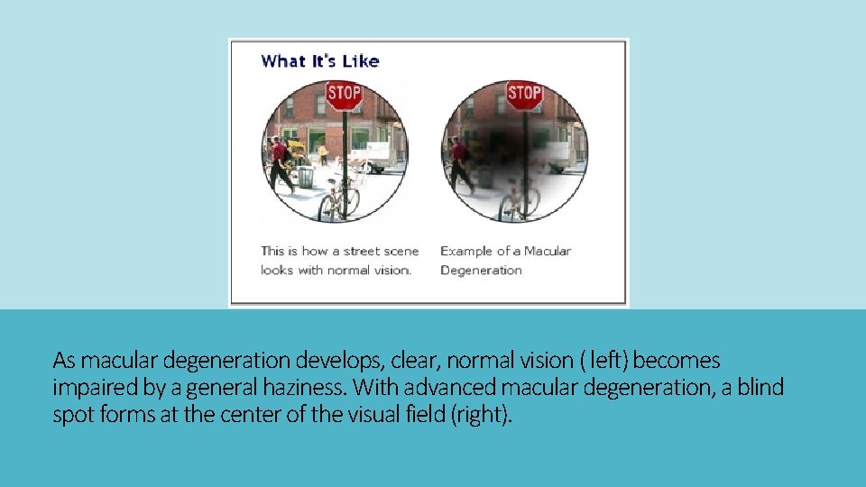 As macular degeneration develops, clear, normal vision ( left) becomes impaired by a general