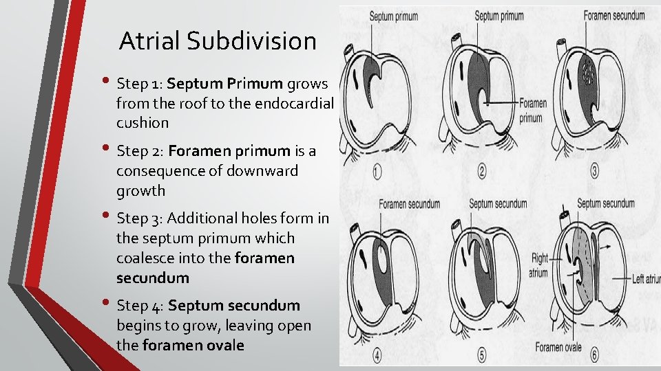 Atrial Subdivision • Step 1: Septum Primum grows from the roof to the endocardial