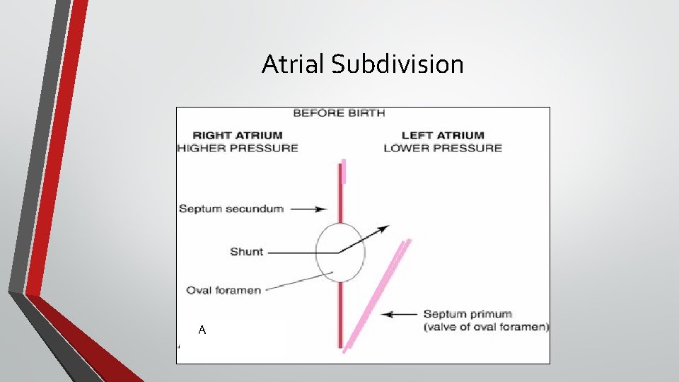 Atrial Subdivision A 