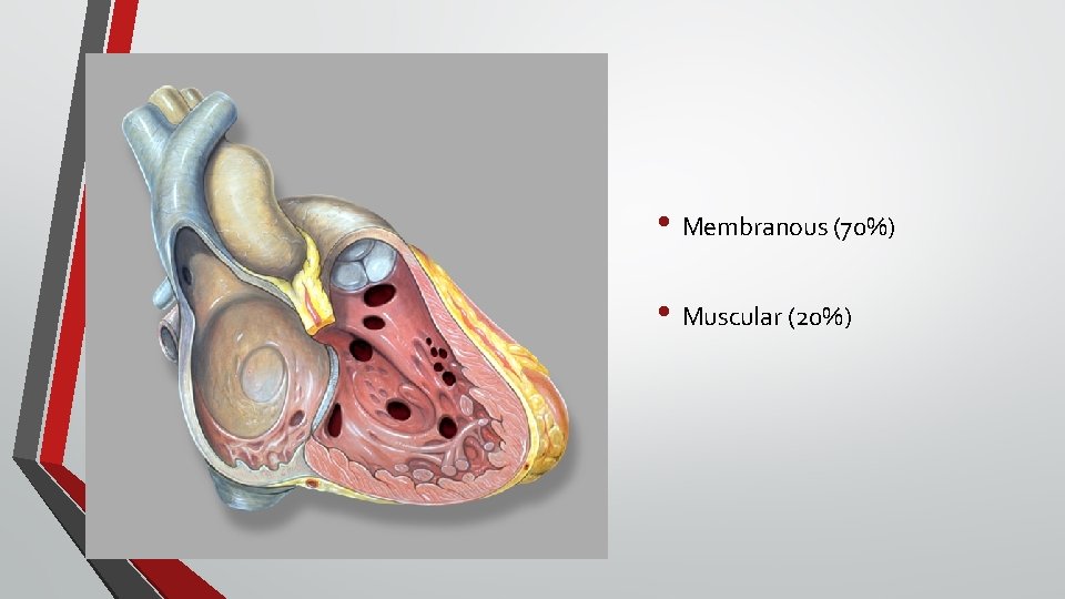  • Membranous (70%) • Muscular (20%) 