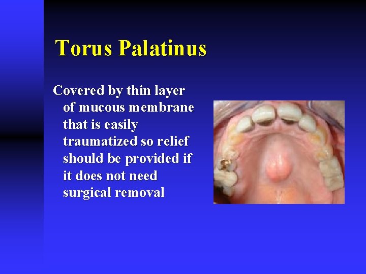 Torus Palatinus Covered by thin layer of mucous membrane that is easily traumatized so