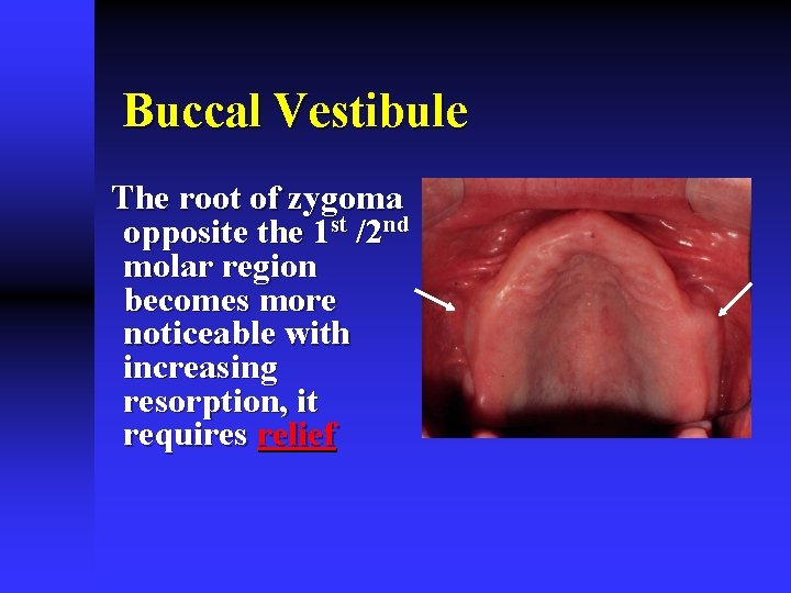 Buccal Vestibule The root of zygoma opposite the 1 st /2 nd molar region