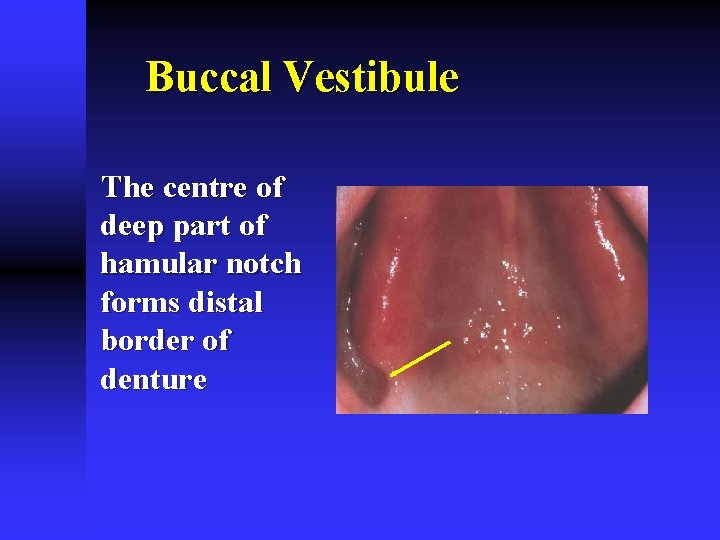 Buccal Vestibule The centre of deep part of hamular notch forms distal border of