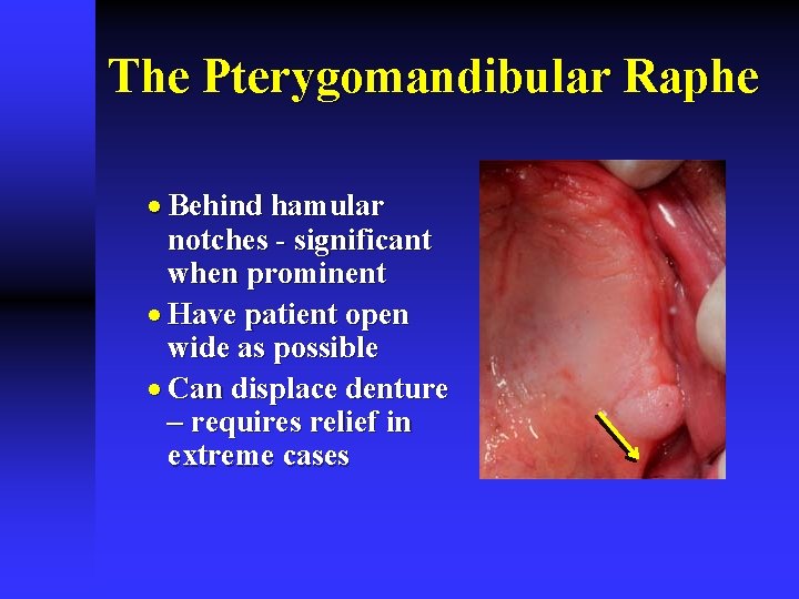 The Pterygomandibular Raphe · Behind hamular notches - significant when prominent · Have patient