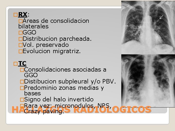 � RX: �Areas de consolidacion bilaterales �GGO �Distribucion parcheada. �Vol. preservado �Evolucion migratriz. �