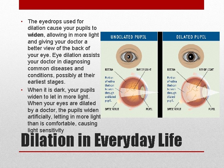 • The eyedrops used for dilation cause your pupils to widen, allowing in