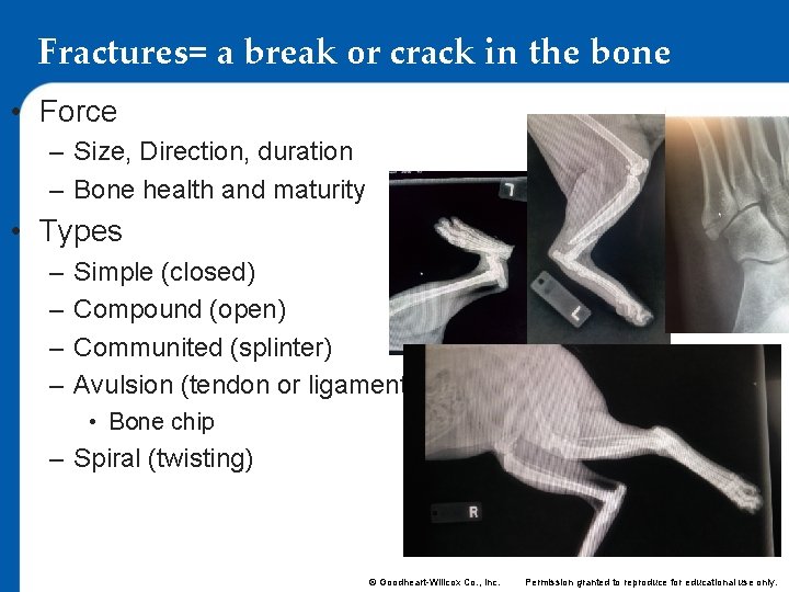 Fractures= a break or crack in the bone • Force – Size, Direction, duration