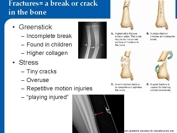 Fractures= a break or crack in the bone • Greenstick – Incomplete break –