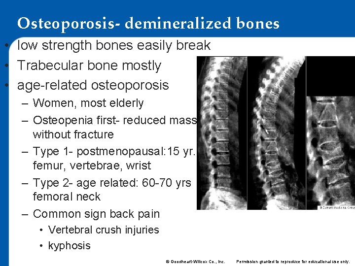 Osteoporosis- demineralized bones • low strength bones easily break • Trabecular bone mostly •