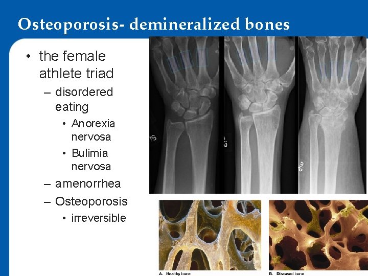 Osteoporosis- demineralized bones • the female athlete triad – disordered eating • Anorexia nervosa
