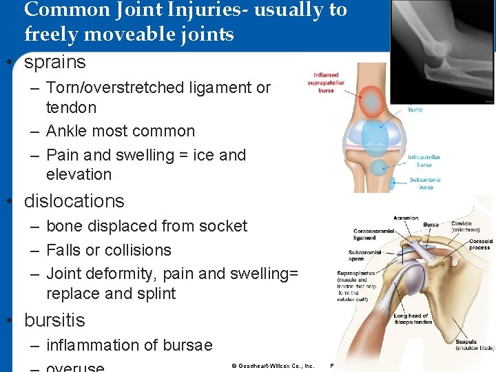Common Joint Injuries- usually to freely moveable joints • sprains – Torn/overstretched ligament or