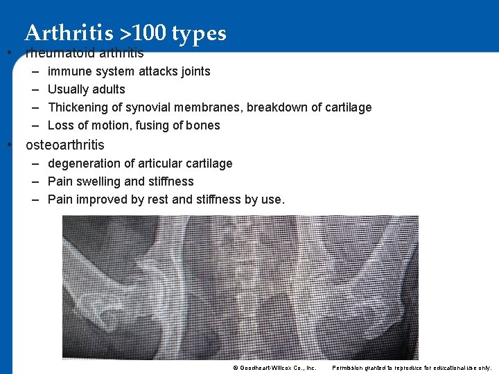 Arthritis >100 types • rheumatoid arthritis – – immune system attacks joints Usually adults