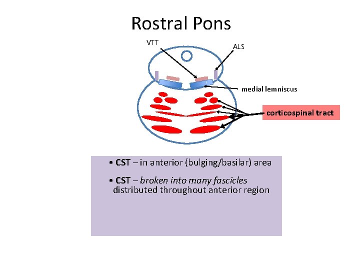 Rostral Pons VTT ALS medial lemniscus corticospinal tract • CST – in anterior (bulging/basilar)
