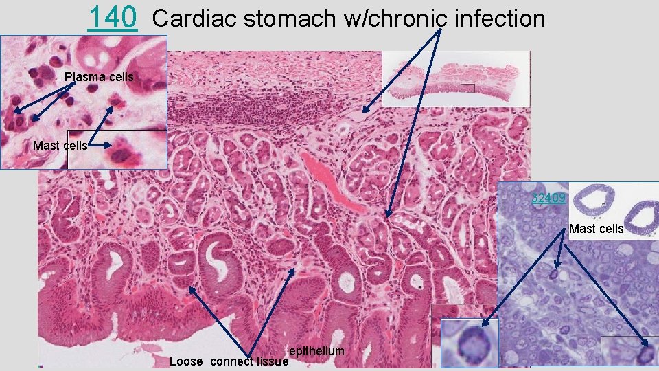 140 Cardiac stomach w/chronic infection Plasma cells Mast cells 32409 Mast cells Loose connect