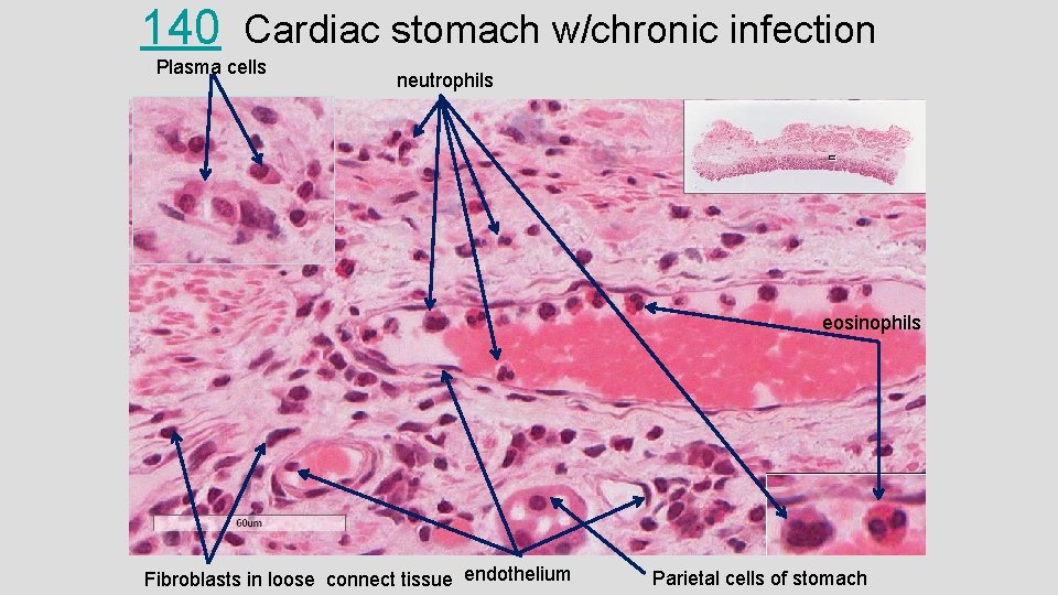 140 Cardiac stomach w/chronic infection Plasma cells neutrophils eosinophils Fibroblasts in loose connect tissue