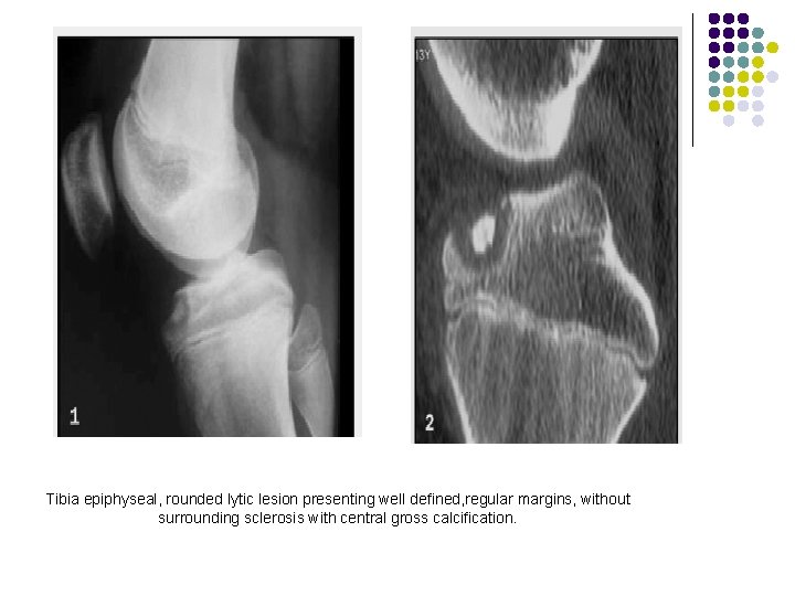 Tibia epiphyseal, rounded lytic lesion presenting well defined, regular margins, without surrounding sclerosis with