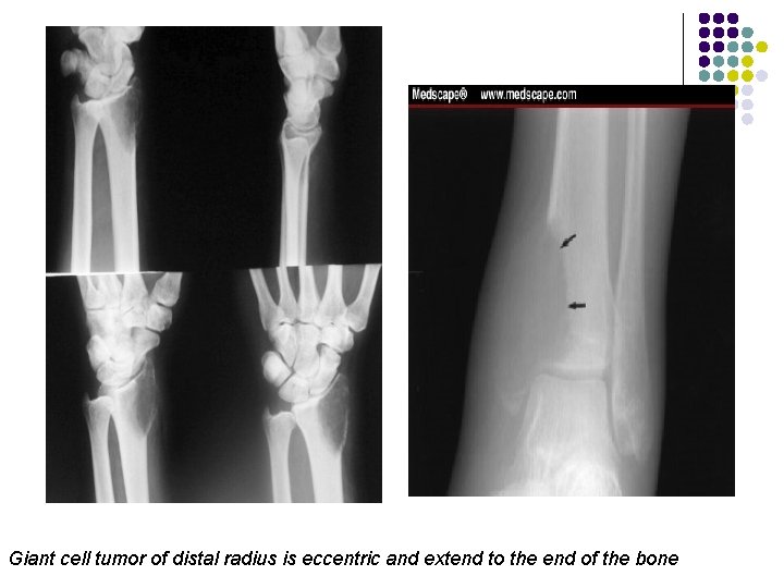 Giant cell tumor of distal radius is eccentric and extend to the end of