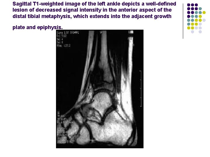 Sagittal T 1 -weighted image of the left ankle depicts a well-defined lesion of