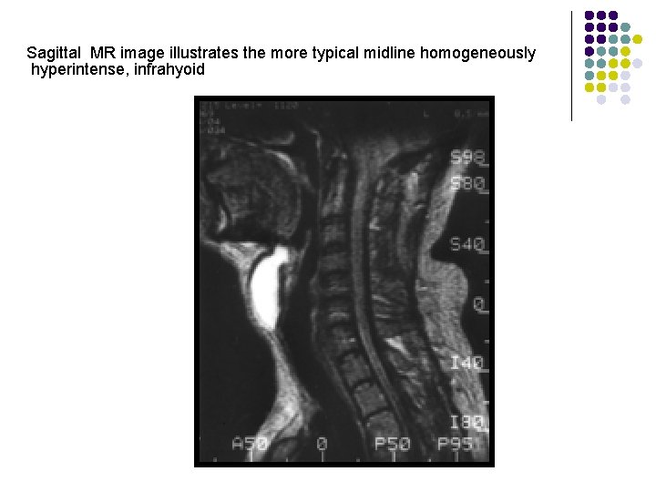  Sagittal MR image illustrates the more typical midline homogeneously hyperintense, infrahyoid 