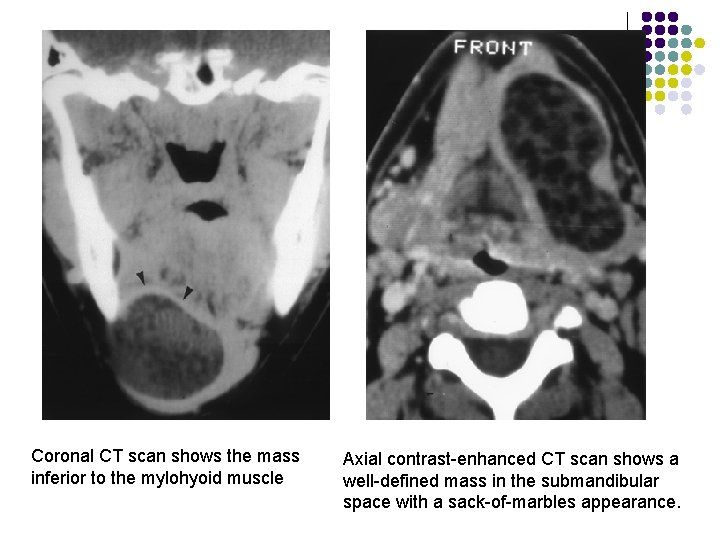 Coronal CT scan shows the mass inferior to the mylohyoid muscle Axial contrast-enhanced CT
