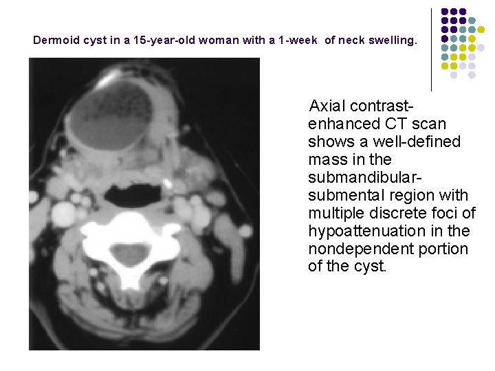  Dermoid cyst in a 15 -year-old woman with a 1 -week of neck