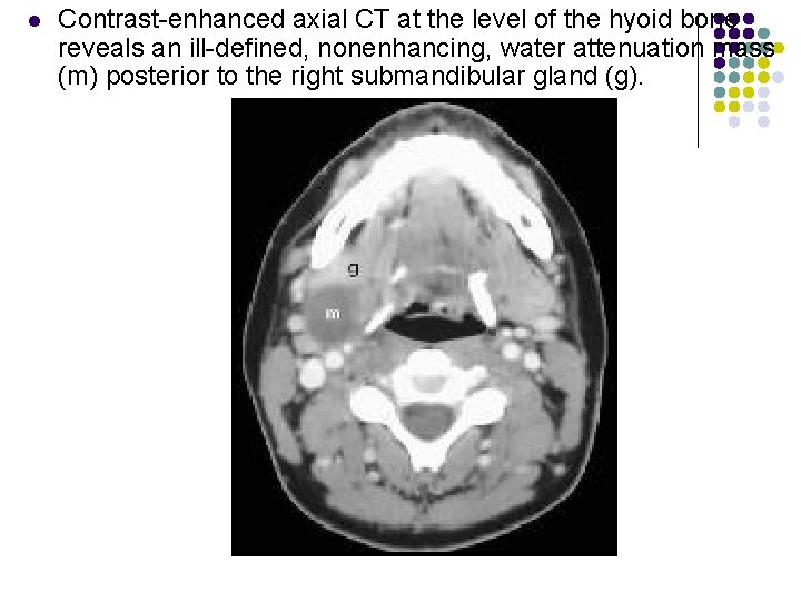 l Contrast-enhanced axial CT at the level of the hyoid bone reveals an ill-defined,