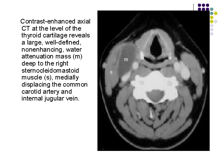  Contrast-enhanced axial CT at the level of the thyroid cartilage reveals a large,