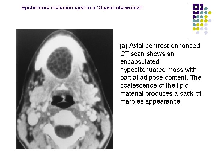  Epidermoid inclusion cyst in a 13 -year-old woman. (a) Axial contrast-enhanced CT scan