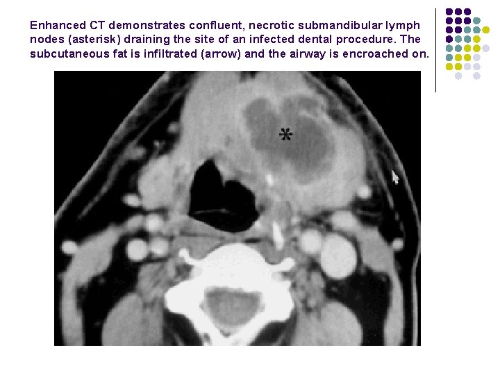 Enhanced CT demonstrates confluent, necrotic submandibular lymph nodes (asterisk) draining the site of an